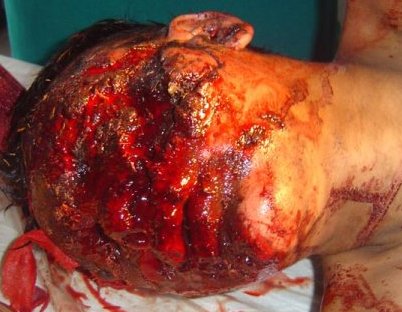 face destroyed by blast